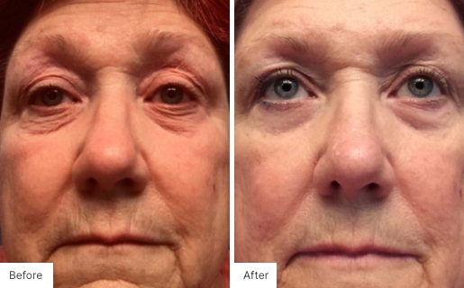 1 - Before and After Real Results photo of a woman's face.
