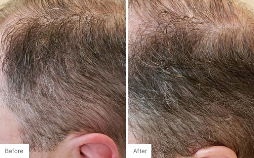 7 - Before and After Real Results picture of a man's scalp.